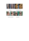 IPL Equipment (Skin Rejuvenation)