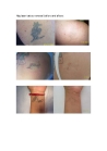 Yag Laser Tattoo Removal  DY-C1