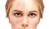 Acne Treatment With Laser Process