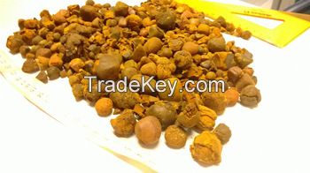 Gallstone