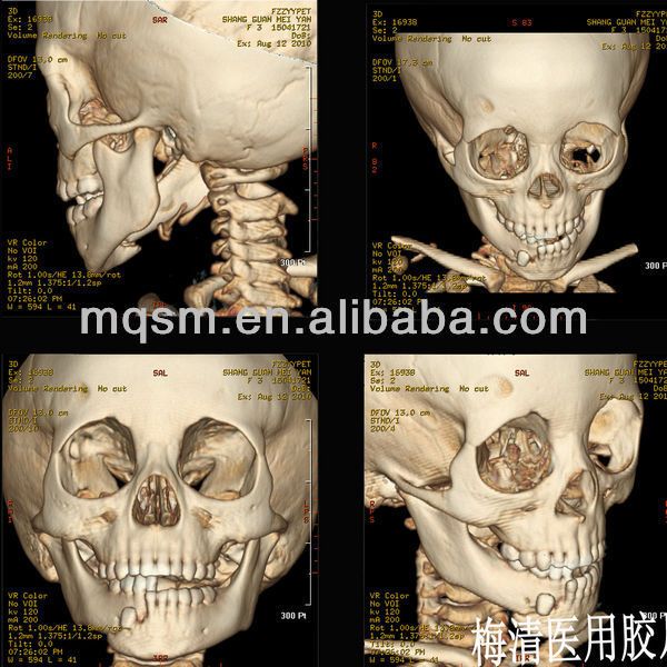 Dry Imaging medical x-ray film for Laser Printer