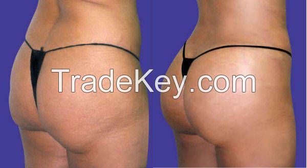 Hydrogel Buttocks Injections For  Enhancement