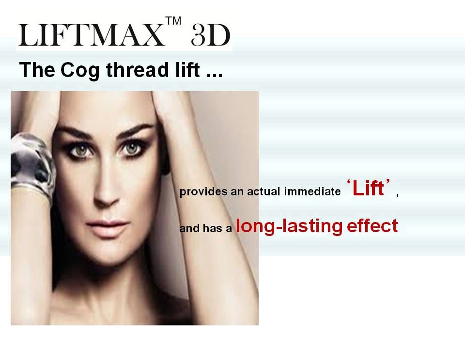LIFTMAX3D Cog Thread Implant