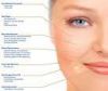 Sell Hyaluronic Acid Fillers