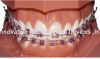 Sell dental orthodontic 80 mesh base bracket brace braquet