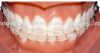 Sell Dental Orthodontic Easthetic Ceramic Bracket
