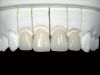 Sell All Ceramic Restoration Denture