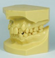 malocclusion jaw mould