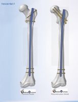 Orthopedic / surgical Implants ( TRAUMA ) At Rock Bottom prise { dedaniaATgmail }