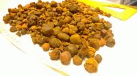 Gallstone