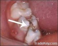 Sell Toothache treatment