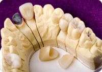 Sell Dental Empress Veneer & Onlay & Inlay