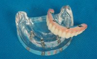 Sell dental implant restorations