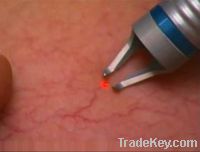 spider vein laser removal