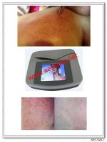 Sell Fractional RF for Vascular and Spider Vein Removal