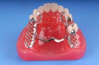 dental cast partial framework