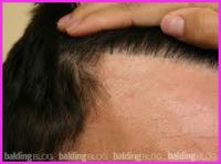 Sell injection skin toupee