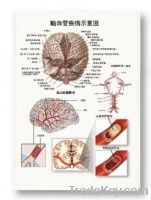 3D Cerebrovascular Disease Chart