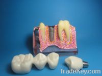 Sell  implant dental model, dental model
