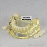 Sell Dental teeth study implant model 1 implant and 3 tooth can move Z