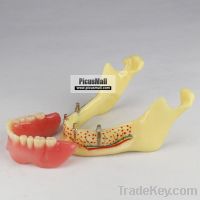 Sell Dental Teeth Implant Model Of The Lower Jaw For Study And Teach Z