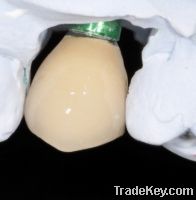 Sell Dental Implant Crown denture