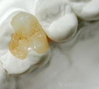 Sell Dental Composite Inlay/Onlay Denture porcelain crowns