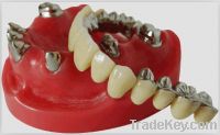 Sell false teeth Dental Telescopic Crown
