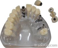 Sell Implant Single Unit and Bridge Denture