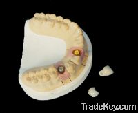 Sell Dental Implant Prosthetics with Removable Teeth Restorations