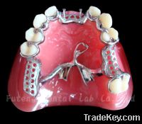 Sell Dental Removable Casting Metal Framework and Casting Partial Dent