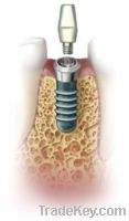 Sell Customized Titanium Hardware of Dental Implants Bases and Abutmen