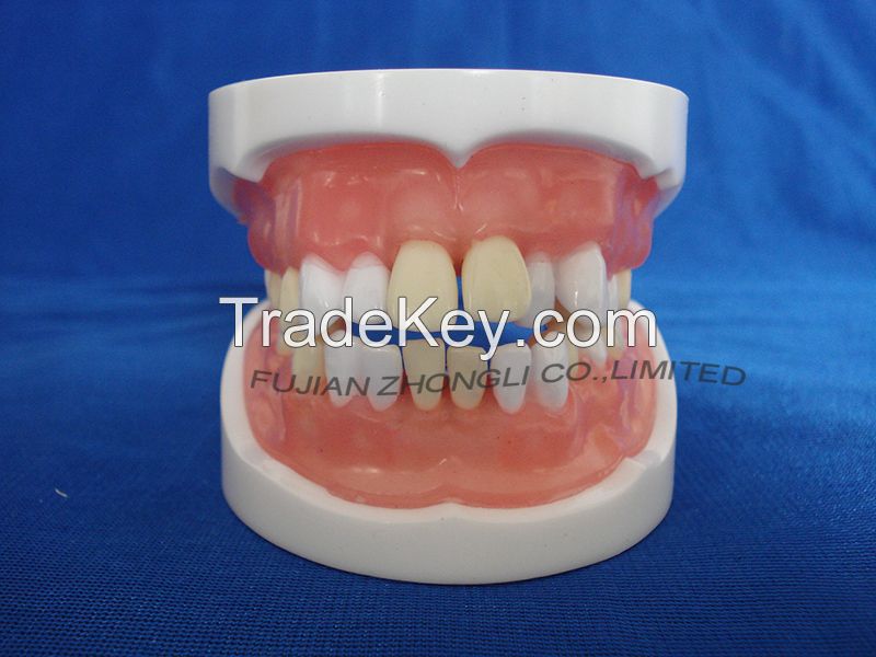 typodent dental jaw model for practice extract tooth
