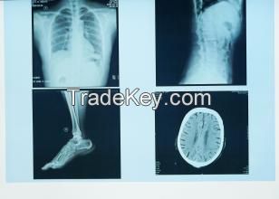 Drypix 8*10 Japan Xray Medical Dry Laser Imaging X-ray Film