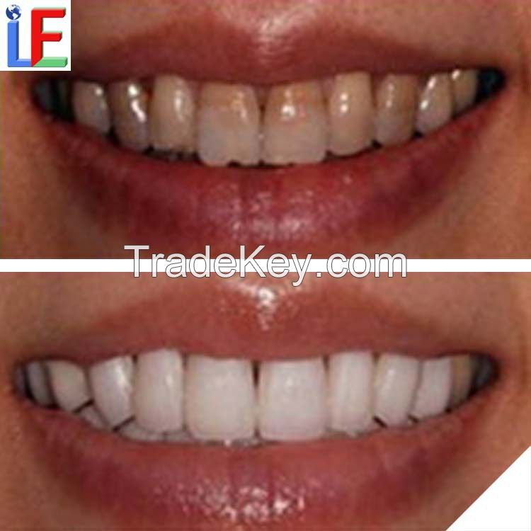 Distributors Wanted Beauty Salon Equipment Dental Teeth Whitening Kits