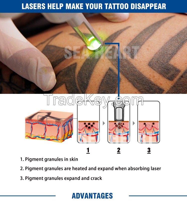 Hot sale Q switch ND Yag laser tattoo removal machine with CE ISO certificate