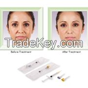 Beauty injection /acido hialuronico for deep wrinkle derm 1mlsyringe