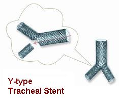Tracheal Stent