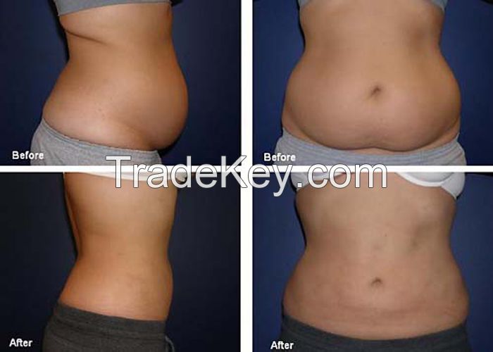 Laser LIipolysis For Belly Fat Removal