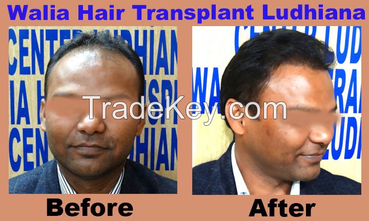 Walia Hair Transplant India Affordable Cost 