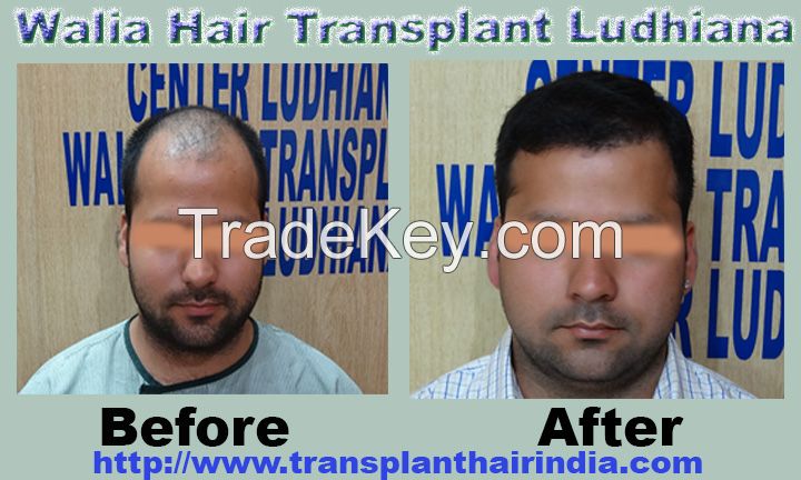 Walia Hair Transplant India Affordable Cost 