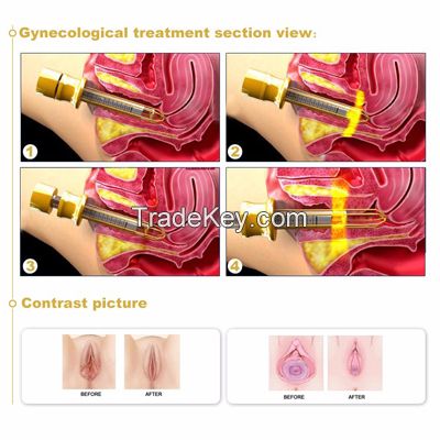 professional 10600nm 50w fractional laser vagina tightening co2 laser