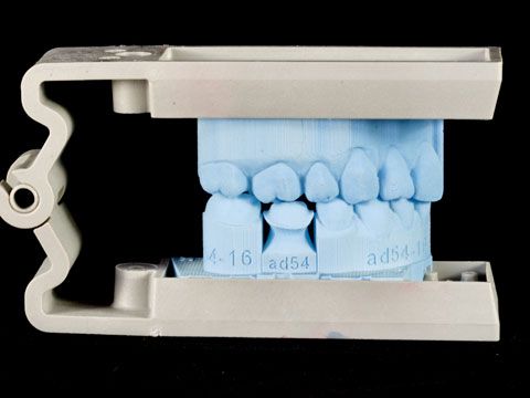 Dental crowns with 3D printing model dental supplies