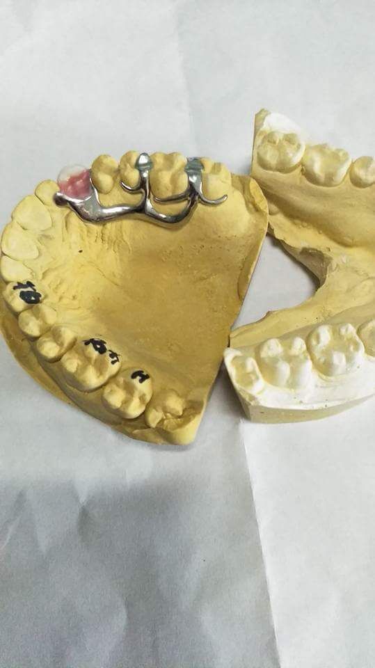 Dental metal framework cast partial metal denture dental supplies
