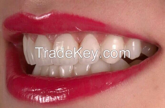 Dental emax  ceramic veneers dental supplies