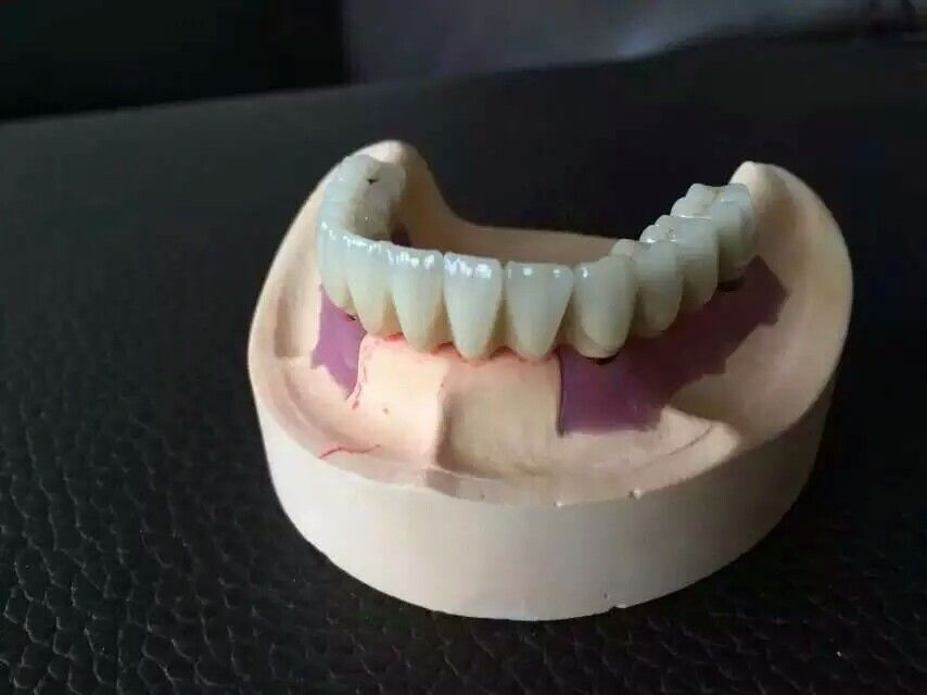 Implant denture dental restorations dental supplies