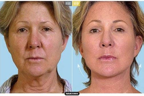 Long lasting Anti Aging PLLA Sculptra aesthetic injection