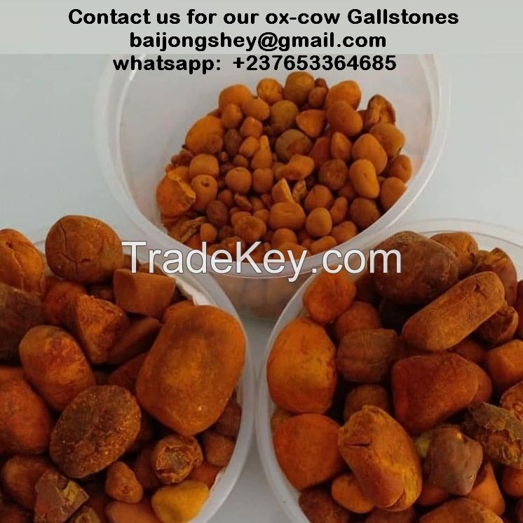 gallstone