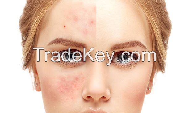 Acne Treatment With Laser Process
