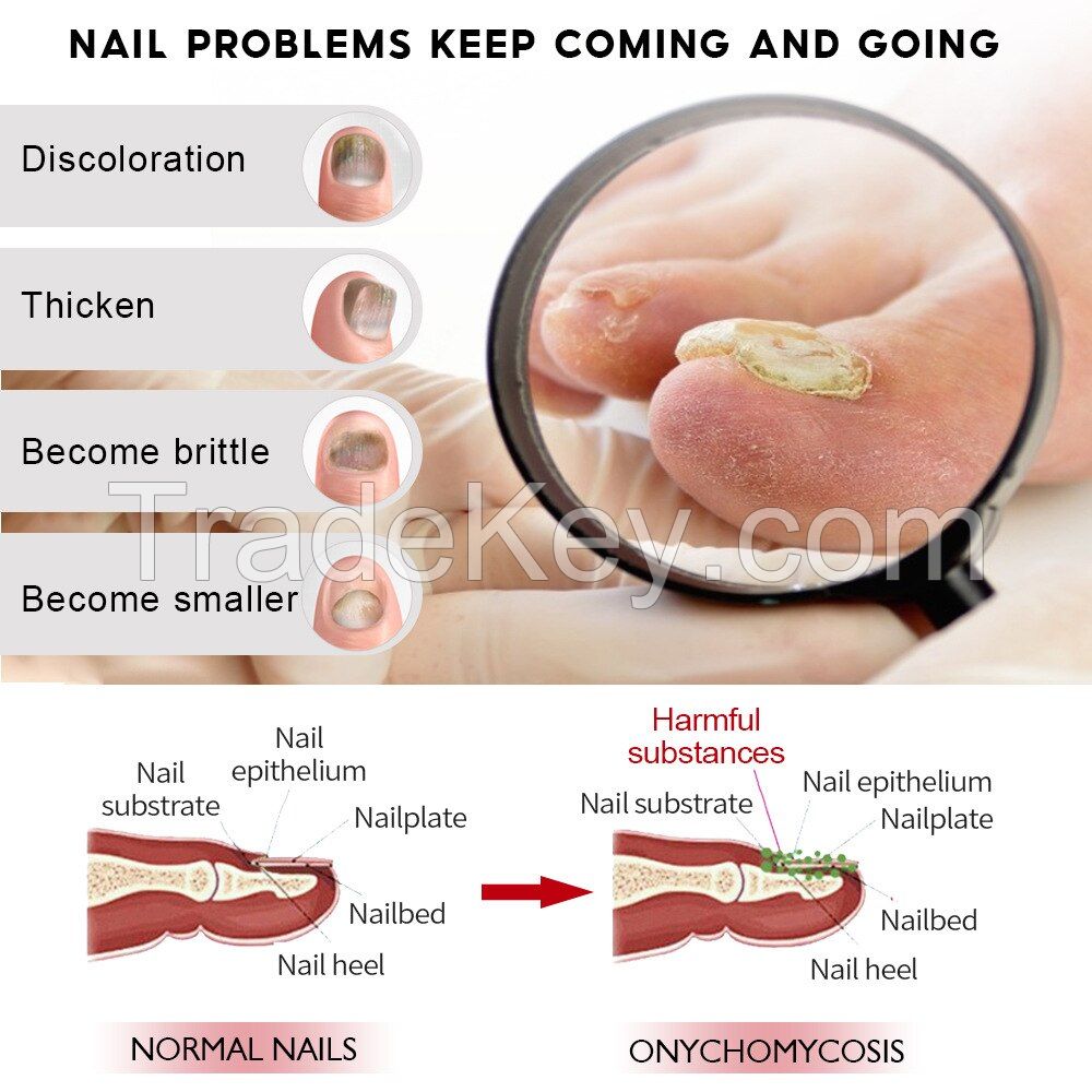 Natural Anti Fungal Hand and Foot Nail Repair Cream for Damaged Nails and Leuconychia